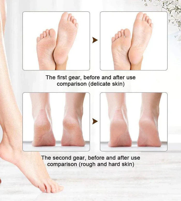 Foot File Callus